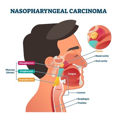 Nasopharyngeal Carcinoma Tumor: কারণ, লক্ষণ, রোগ নির্ণয় ও চিকিৎসা